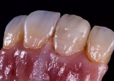 خرید جرمنی Amanjilbach Zirconia تاج دندان چگالی بالا با سفارشی سازی تولید آنلاین