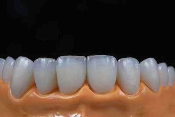 خرید تاج های زیرکونیا بسیار شفاف زیبایی مناسب با ظاهر طبیعی تولید آنلاین